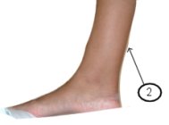picture of area of foot pain